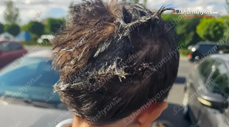 A strange incident at “Ringo’s Donut”: A 3-year-old child’s hair was covered in glue